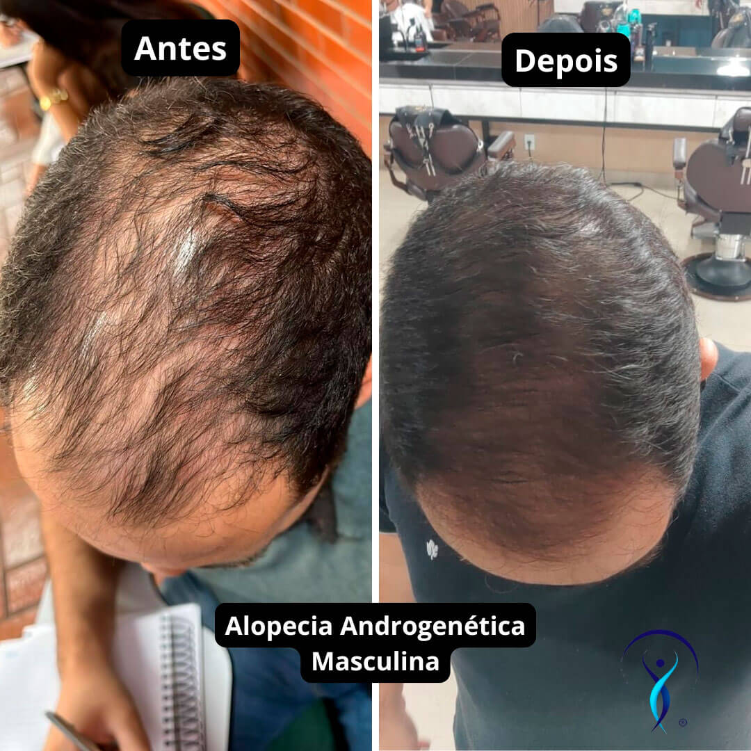 Alopecia-Androgenética-Masculina-Andre-2
